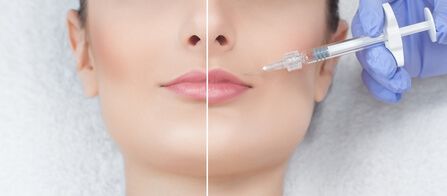 Lip filler