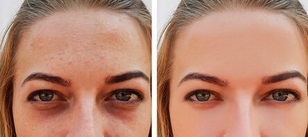 Before after acne